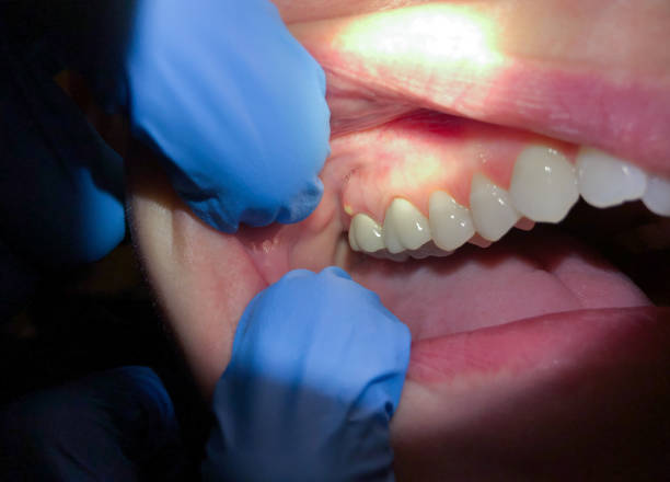 Best Emergency Treatment for Dental Infections or Abscesses in Millbrook, NY